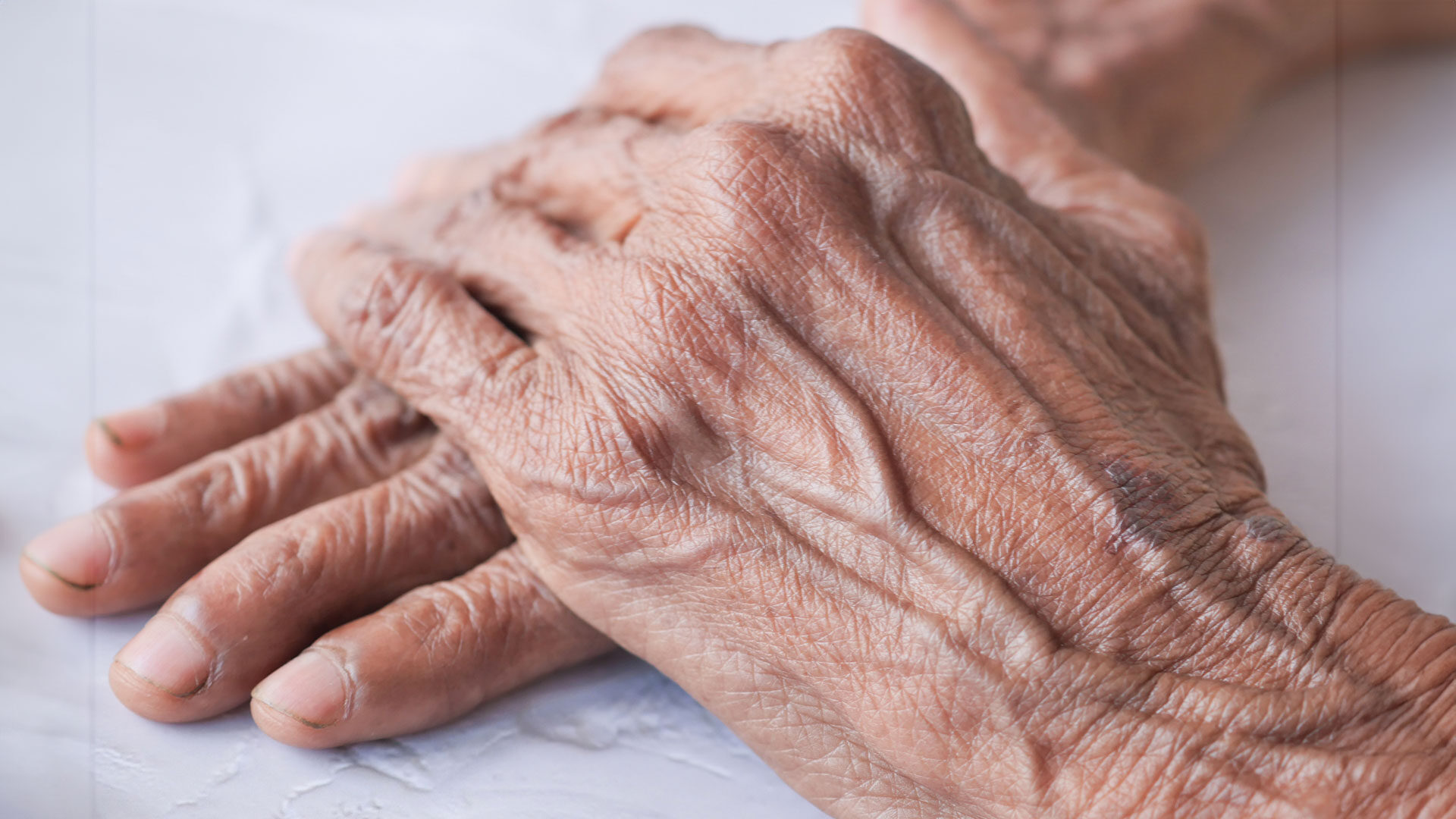 Close-up of an individual with Parkinson's hands, embodying the challenges and resilience in managing the disease, and emphasizing the importance of comprehensive care strategies, lifestyle adjustments, and professional support to thrive despite Parkinson's.